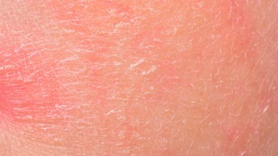 Dermapixel: Dermatitis seborreica: No es piel seca