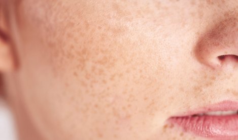 Dermapixel: Dermatitis seborreica: No es piel seca